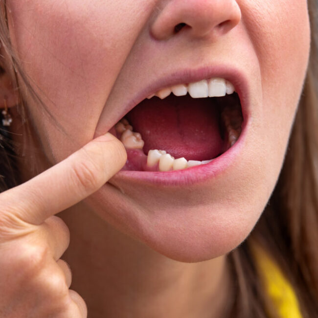 Lower jaw missing tooth