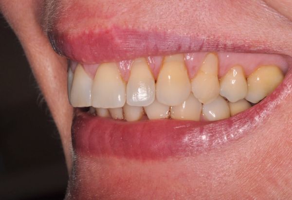 After - Peacock Dental Spa