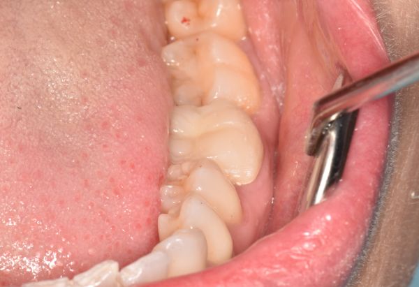 After - Peacock Dental Spa