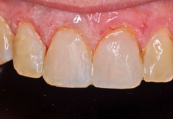 After - Peacock Dental Spa