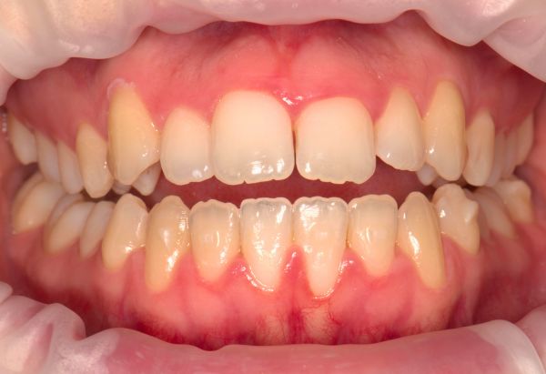 Before - Peacock Dental Spa