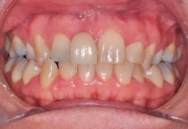 Before - Peacock Dental Spa