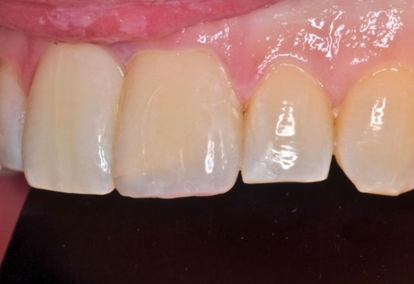 After - Peacock Dental Spa