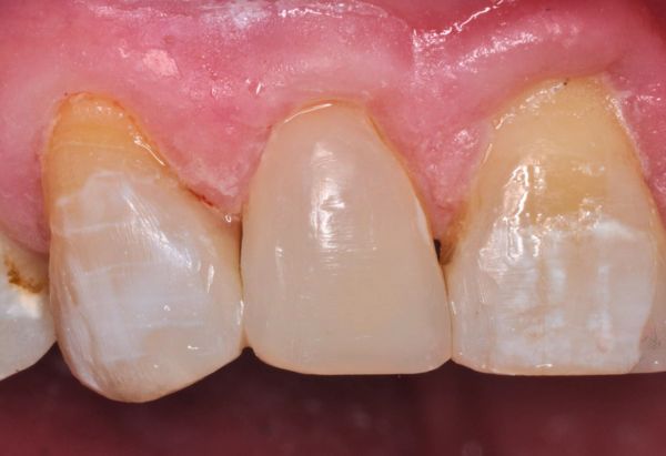 After - Peacock Dental Spa