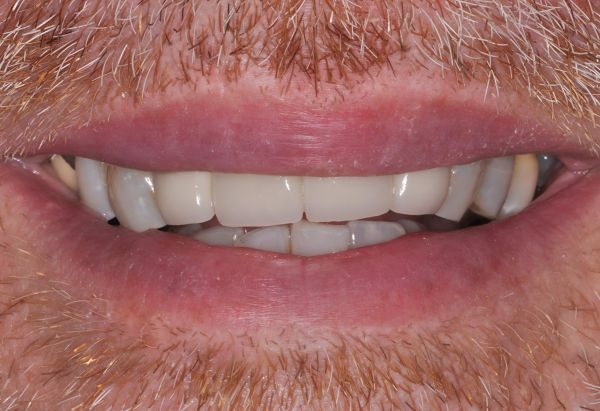 After - Peacock Dental Spa