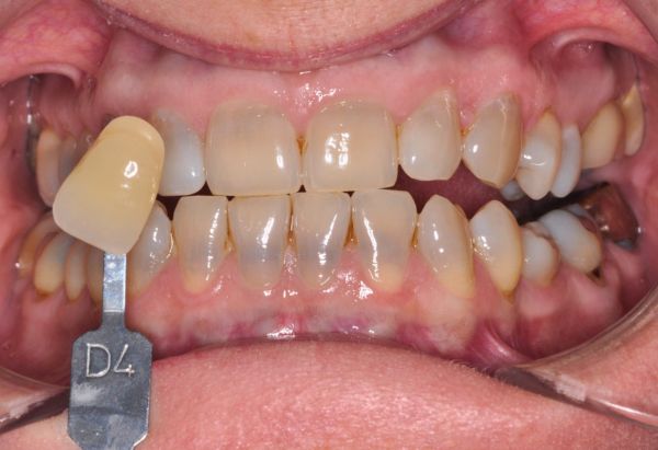 After - Peacock Dental Spa