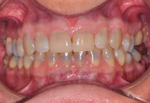 Before - Peacock Dental Spa