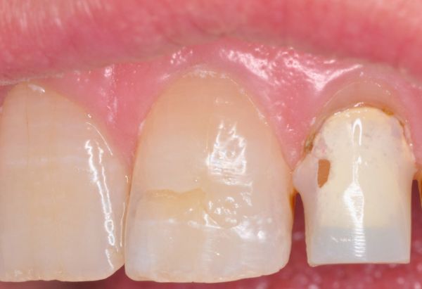 Before - Peacock Dental Spa