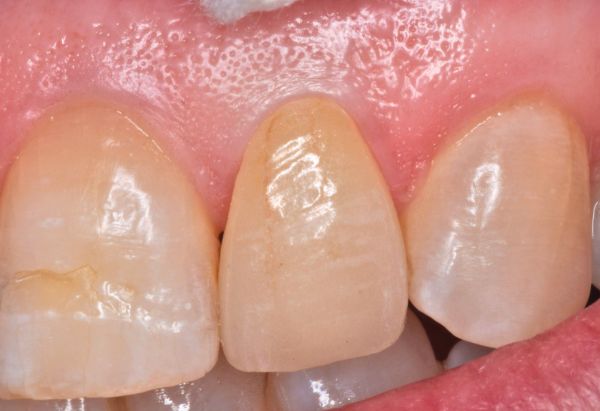 After - Peacock Dental Spa