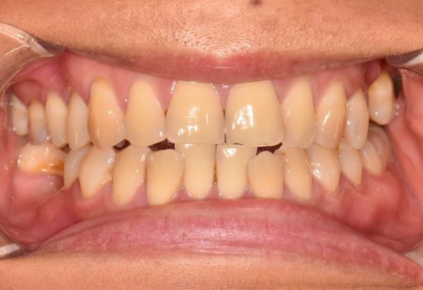 Before - Peacock Dental Spa