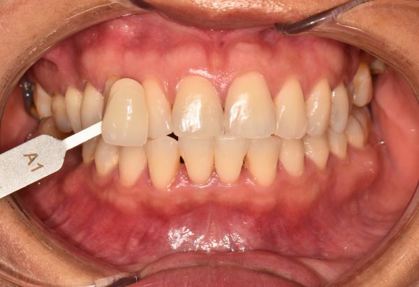 After - Peacock Dental Spa