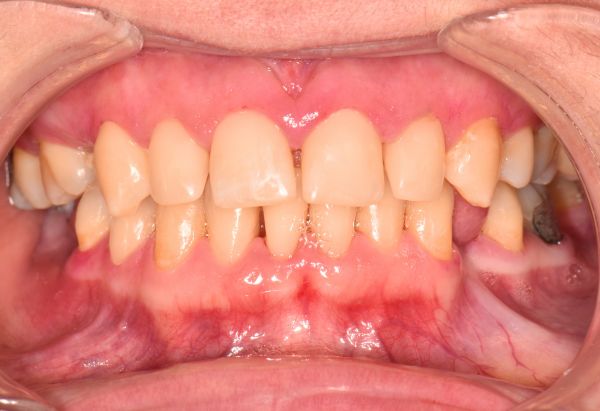 After - Peacock Dental Spa