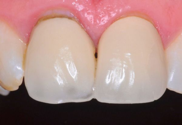 Before - Peacock Dental Spa