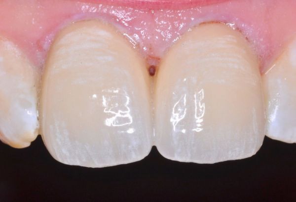 After - Peacock Dental Spa