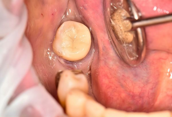 After - Peacock Dental Spa