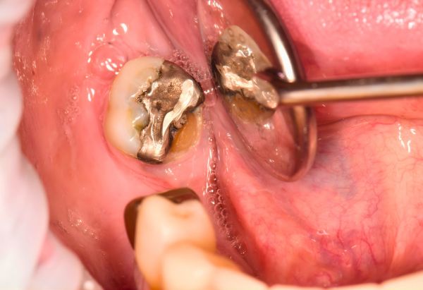 Before - Peacock Dental Spa