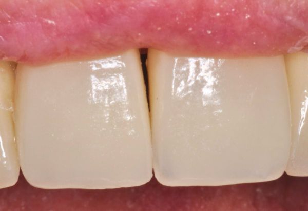 After - Peacock Dental Spa