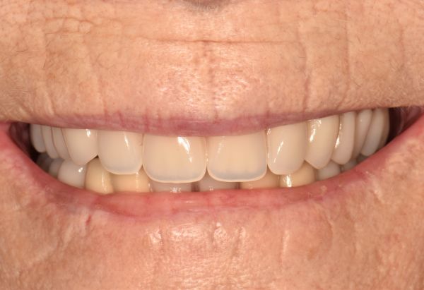 After - Peacock Dental Spa