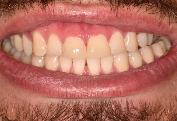 After - Peacock Dental Spa