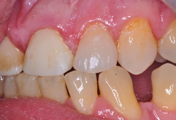 After - Peacock Dental Spa