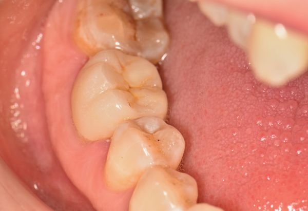 After - Peacock Dental Spa