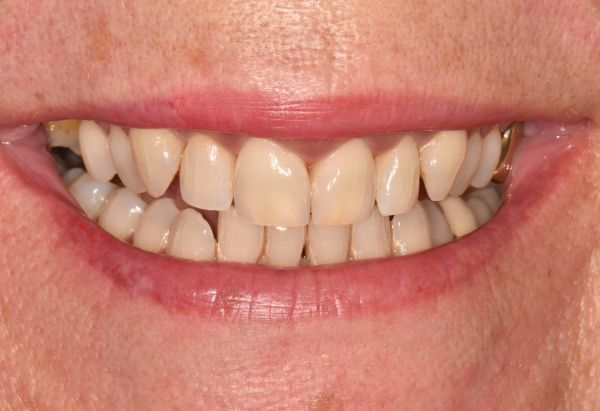 After - Peacock Dental Spa