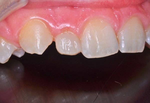 After - Peacock Dental Spa