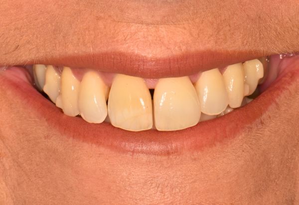 After - Peacock Dental Spa