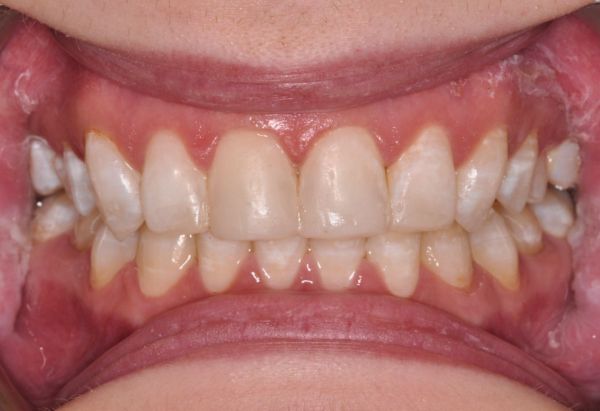 After - Peacock Dental Spa