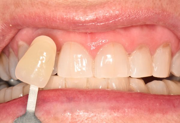 After - Peacock Dental Spa