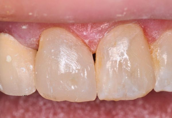 After - Peacock Dental Spa