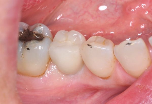 After - Peacock Dental Spa