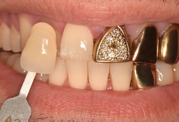 After - Peacock Dental Spa