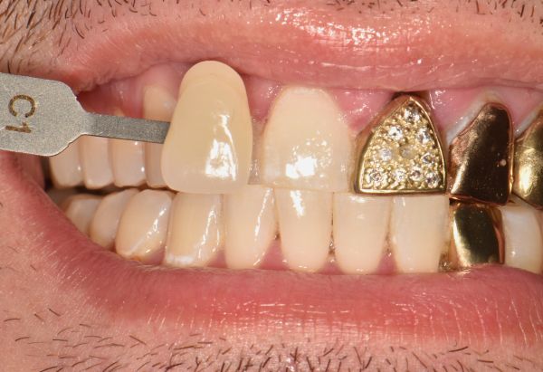 Before - Peacock Dental Spa