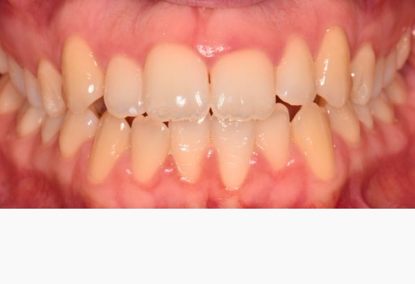 Before - Peacock Dental Spa