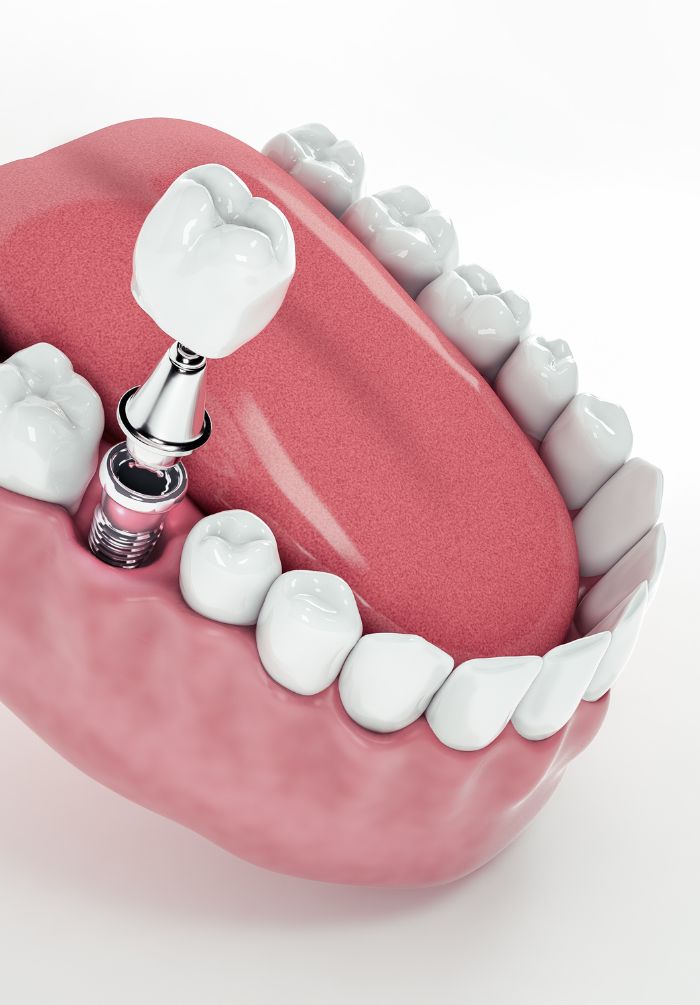 Treatment -  Peacock Dental Practice