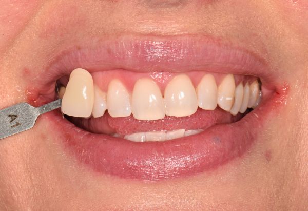 After - Peacock Dental Spa