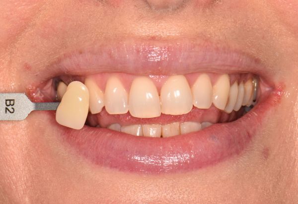 Before - Peacock Dental Spa